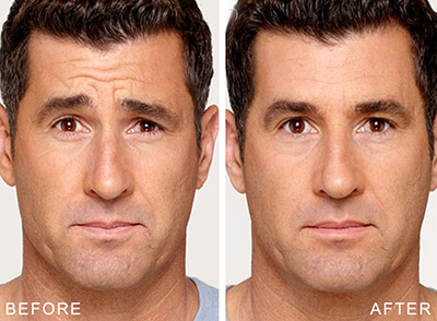 cosmetic injections before and after