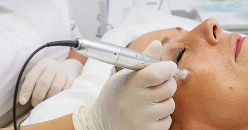 edermastamp skin needling procedure in progress